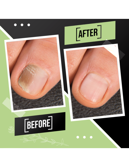 Tratamiento de Uñas FUNGUSLESS