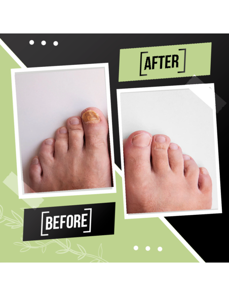 Tratamiento de Uñas FUNGUSLESS