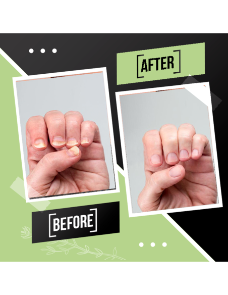 Tratamiento de Uñas FUNGUSLESS